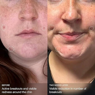 TOPICALS Clearly Breakout Mask 30ml