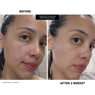 KATE SOMERVILLE Eradikate 3% Sulfur Daily Foaming Cleanser 120ml