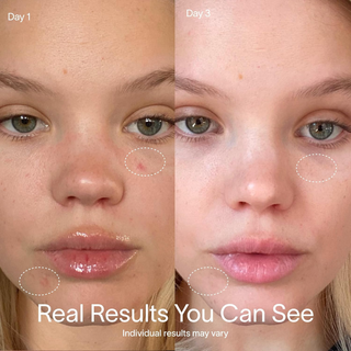 SOLAWAVE Bye Acne 3-Minute Pimple Spot Treatment