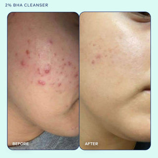 Skinfix Acne+ 2% BHA Cleanser 148ml
