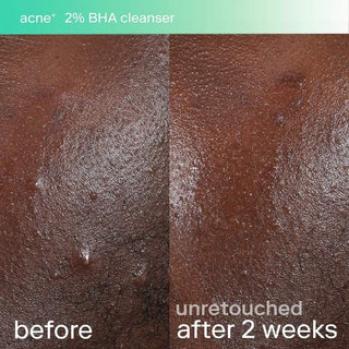Skinfix Acne+ 2% BHA Cleanser 148ml