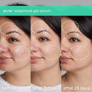 SKINFIX Triple Threat Acne Set