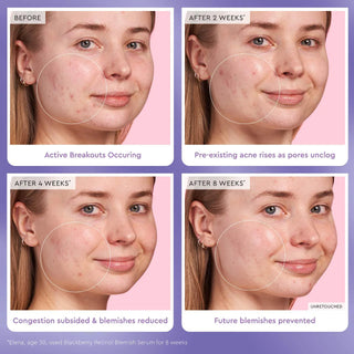 GLOW RECIPE Blackberry Retinol Blemish Serum