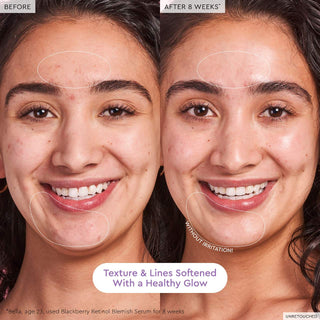 GLOW RECIPE Blackberry Retinol Blemish Serum