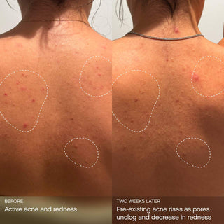 TOPICALS Clearly Acne Mist 100ml