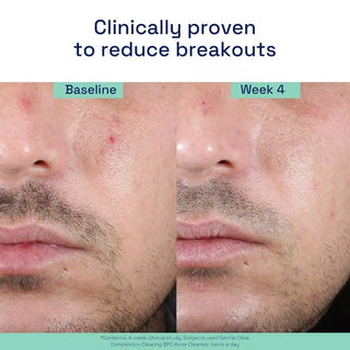 CETAPHIL Gentle Clear Complexion Clearing Acne Cleanser 124ml